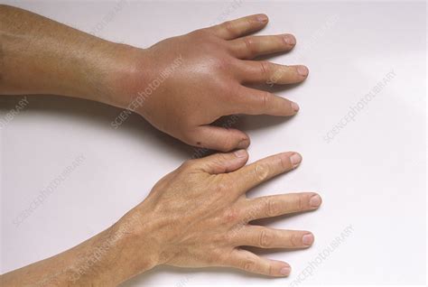 While most <b>stings</b> cause <b>pain</b> and swelling, some people suffer severe allergic reactions known as anaphylaxis. . Muscle and joint pain after wasp sting